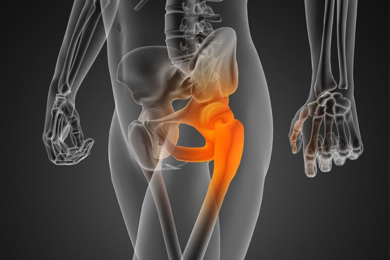 Revision (reoperation) of total hip endosprothesis